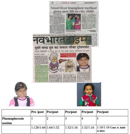 Liver Transplant Untitleddesign6_npmcu_434